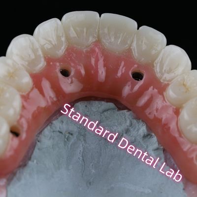 comprare Implantazione dentale corona PFZ porcellana stratificata vite di zirconia trattenuta con gomma rosa fabbricazione online