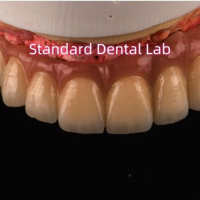 comprare PFM Digital Non Precious Metal Porcellane Crowns Bridge Alta estetica naturale fabbricazione online