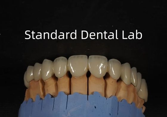 comprare Cina Dental Lab Corona metallica ceramica PFM Corona alta estetica fabbricazione online