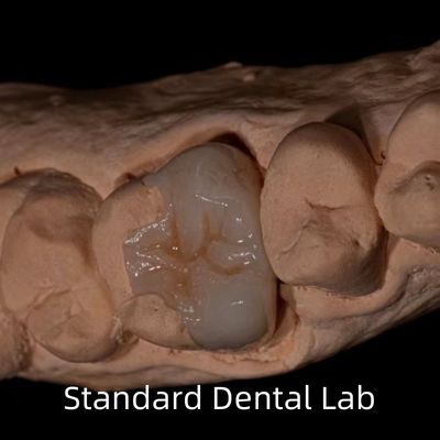 comprare Traslucidità Emax Zirconia Dental Inlay Onlay Crown per ripristinare la forma naturale della cavità fabbricazione online