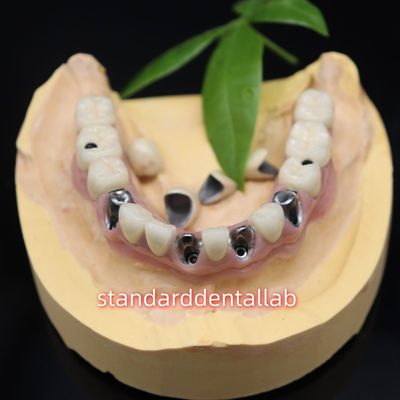 comprare Impianti dentali a vite di metallo corone ceramiche ponte Malo fabbricazione online