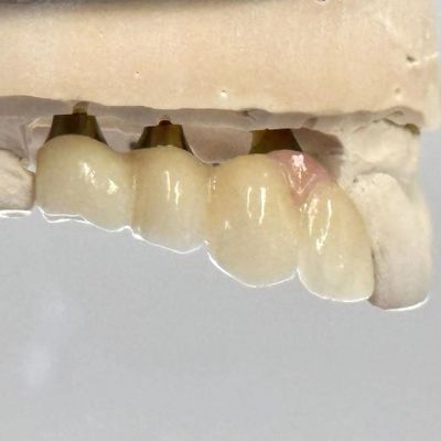 comprare Impianto a vite di porcellana circonia cemento trattenuto Forma di testa esagonale per estetica personalizzata fabbricazione online