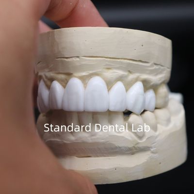 comprare Corone dentali diagnostica ceretta alta estetica dal laboratorio dentale cinese fabbricazione online
