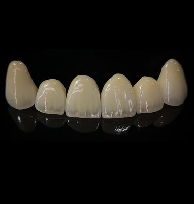 comprare Confortevole corona di zirconia con un buon allineamento ed estetica di precisione fabbricazione online
