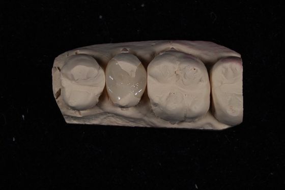 comprare Forza Emax Corona di rivestimenti in ceramica con eccellente resistenza alle macchie / biocompatibilità fabbricazione online