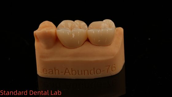 comprare Corone di laboratorio dentale 3D Pro ad alta traslucidità Corone di zirconia completa con garanzia di 5 anni fabbricazione online