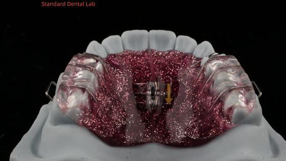 comprare Espansione e distalizzazione dei denti regolare espander in bocca ortodontista espander del palato fabbricazione online