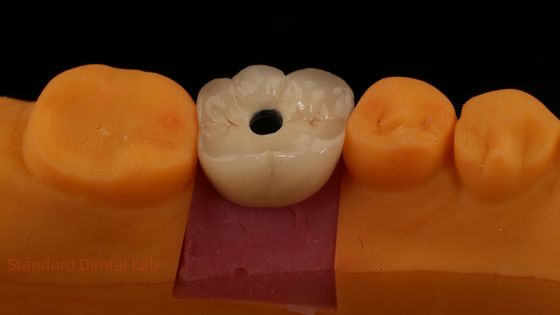 comprare Croce di impianto dentale in porcellana stratificata in zirconia di PFZ a vite da laboratorio dentale certificata ISO FDA CE con garanzia di 5 anni fabbricazione online