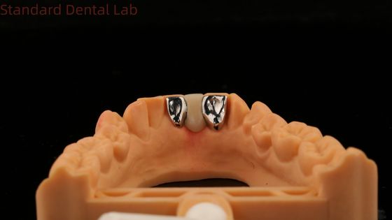 comprare Dental PFM Maryland Bridge Alta estetica FDA certificata con Vita Porcelian China Dental Lab fabbricazione online