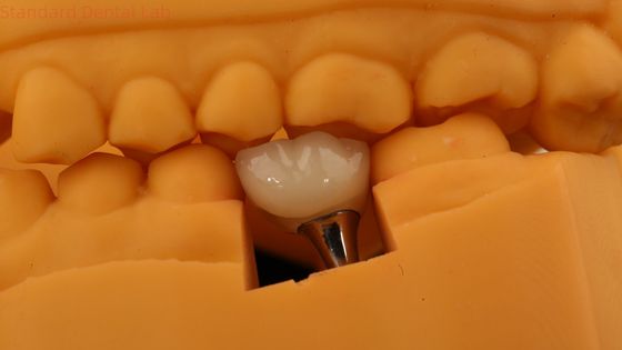 comprare Corona di impianto dentale a vite con modello di stampa 3D fabbricazione online