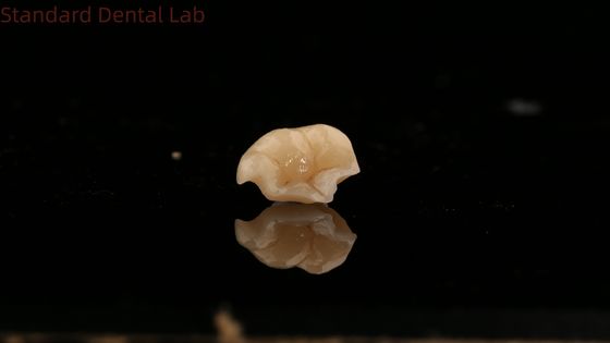 comprare Forza Emax Corona Ceramica Dental Onlay con eccellente resistenza alle macchie fabbricazione online