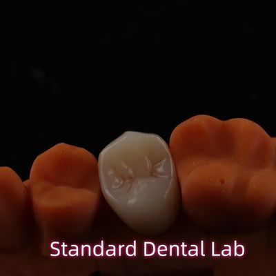 Alto estetico BruxZir Full Contour Zirconia Crowns PFZ Ponte