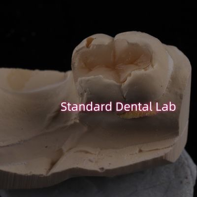 Intaglio dentale in porcellana fusa Intaglio di zirconia Emax Alta estetica
