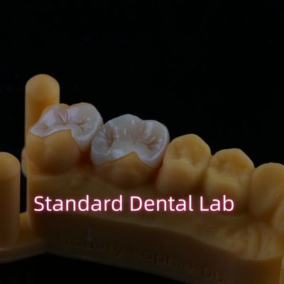 Infissi in metallo Emax in resina composita Zirconia Onlay Overlay