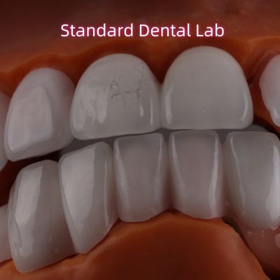 Litio Dicilicato strato Ivoclar Emax Zirconia Veneers laminati Traslucidi OEM ODM