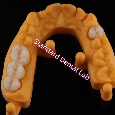 Corona tutti i denti estetici in porcellana ceramica zirconia Ivoclar OEM