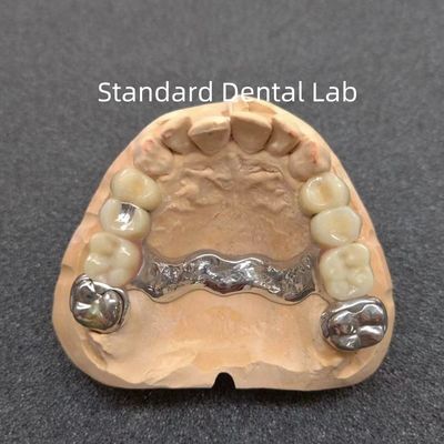 Dentistico di precisione rimovibile Dentistico parziale Dentistica stabile Professionale