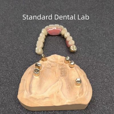 CAD CAM Dente Partiale Protezione dentale Attachment Dental Professional Accurate