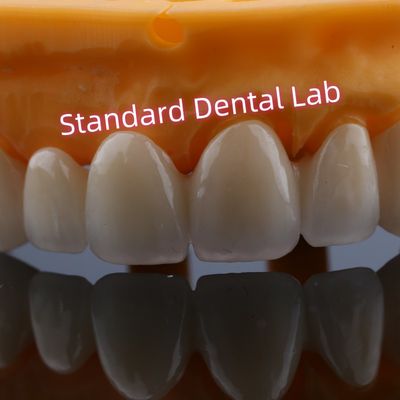 Restauro anteriore di corone di zirconia per denti mancanti