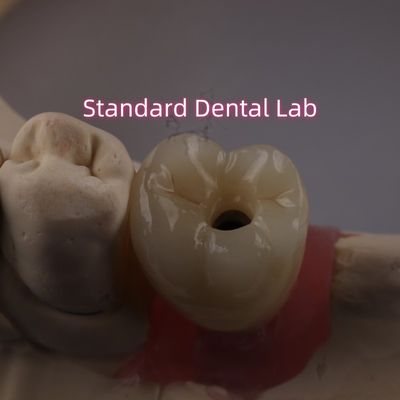 Croce di impianto dentale a vite PFZ in porcellana stratificata in zirconia