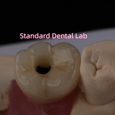 Implantazione posteriore Crown Bruxier Solid Zirconia Screw Ritenuta