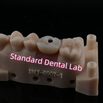 Impianto abutment su misura Corona di contorno completo Vello di zirconia mantenuto