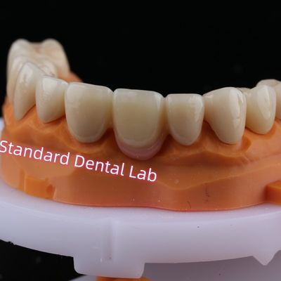Digital CAD CAM fresatura stratificata zirconia ponte corona con porcellana rosa