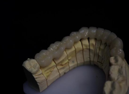 Circonia fusa in porcellana stratificata