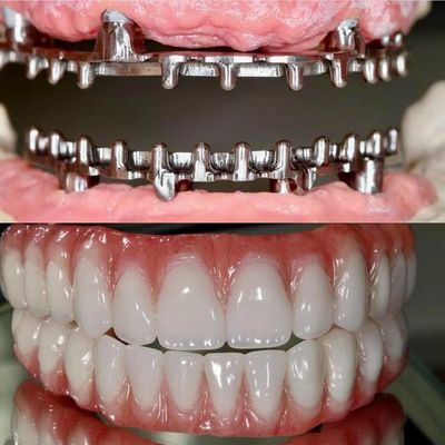 Dental Hybird Malo Implant Bridge Professional Perfetto Fit Certificato FDA