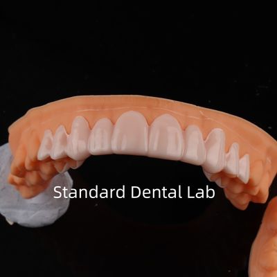 Dental Lab di alta estetica Snap On Smile Standard
