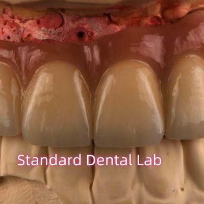 CAD CAM Fresatura PFM Porcellana non preziosa fusa a metallo ponte fisso