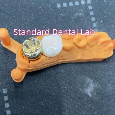 Corona di leghe di metalli gialli non preziosi con corona di zirconia