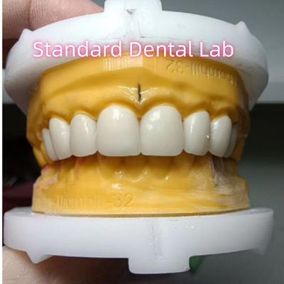 Rivestimenti a corona di zirconia di alto trasparenza estetica