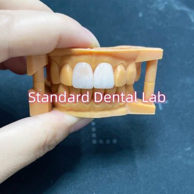 Alta stabilità del colore Ivoclar Emax Veneer laminati Alta traslucidità