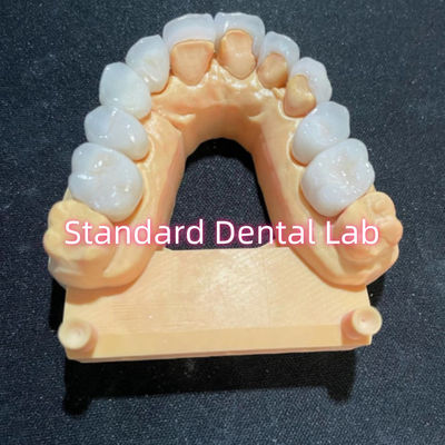 Alta estetica di Hollywood sorriso fresatura Emax laminazioni finiture