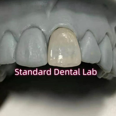 Odontoiatria restaurativa Emax Dental Circonia Corone di porcellana