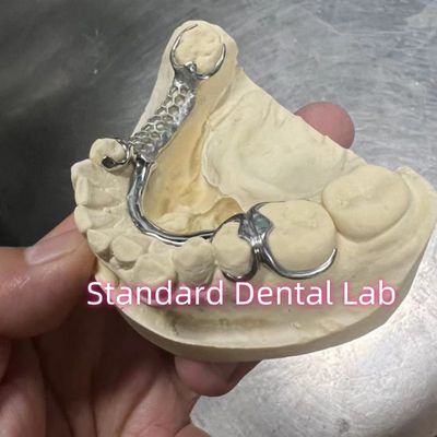 Scheletro di cromo con protesi parziale di metallo ISO