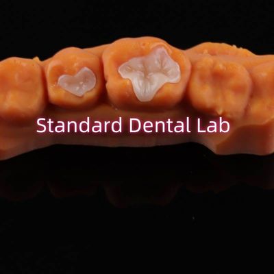 Dental Porcellana Inlay Onlay Overlay Zirconia Emax Composite per le carie dentali