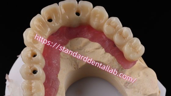 Ponte di impianto a vite in zirconia a più strati Biocompatibile su struttura metallica
