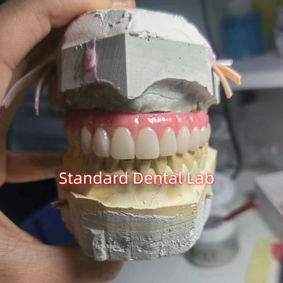 Titanio PMMA ponte dentale a vite corona temporanea