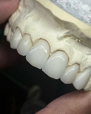 Corona di zirconia a strati di traslucidità per una funzionalità ottimale ed estetica naturale
