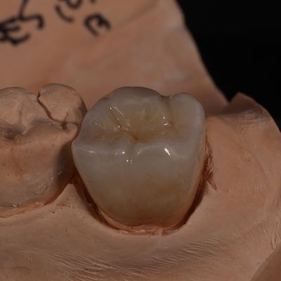 Corona di zirconia trasparente a contorno completo per risultati esteticamente gradevoli