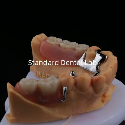 Legatura di metallo parziale struttura protesi 3 forma Exocad stampa laser inferiore finitura parziale