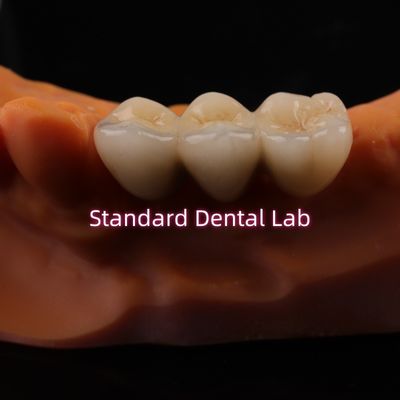 Corone di laboratorio dentale digitale CAD CAM Corone di zirconia a strati traslucida