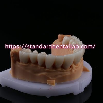 FDA Alta estetica Dental Zirconia Bridge con corona dentale di zirconia in porcellana stratificata