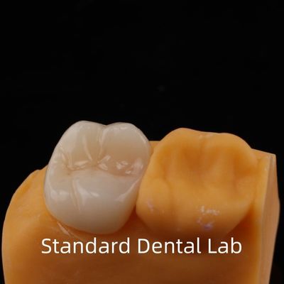 Garanzia di 5 anni Corona di zirconia a contorno completo per denti molari Noritake porcellana realizzata da un laboratorio dentale di fiducia