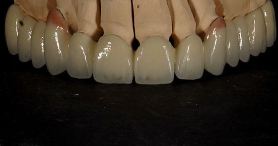 Buona vestibilità Buona estetica Molti strati di zirconia corona di porcellana zirconia ponte