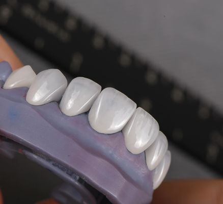 Naturale Emax Veneers Corona Biocompatibilità Sfumatura sbiancante con preparazione minima