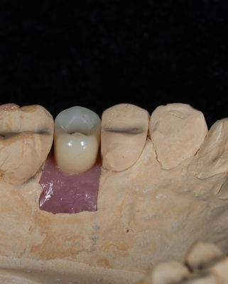 Impianto di cemento a vite per impianti dentali di lunga durata con garanzia di 5 anni