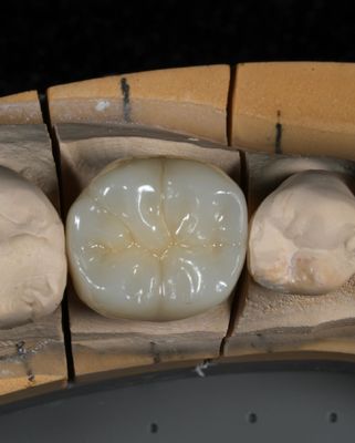 Corone di zirconia a contorno completo, veloce cambio per un adattamento preciso ed estetico in 1 settimana